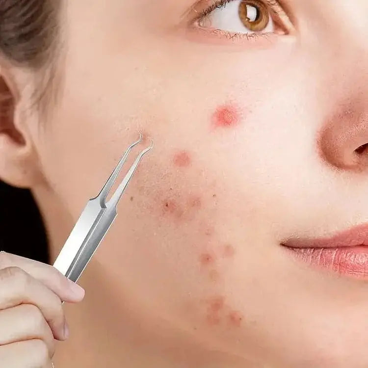 Professional Facial Blackhead Remover Tweezers (3Pcs+Box) Trendslana