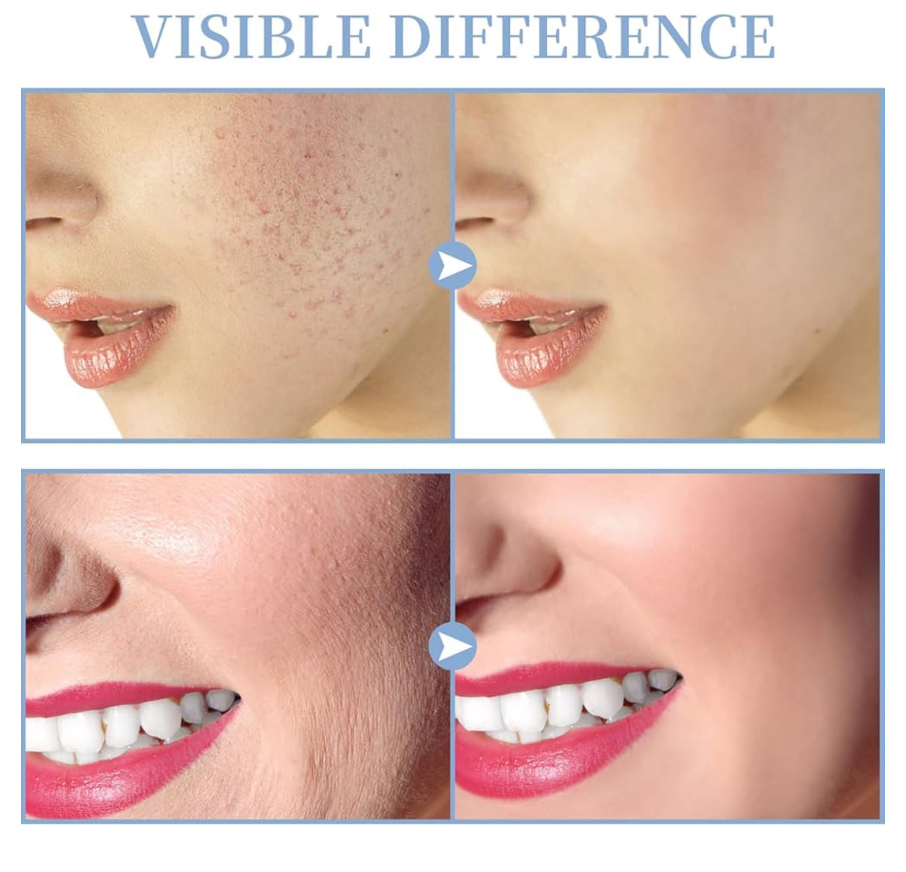 High Frequency Facial Machine